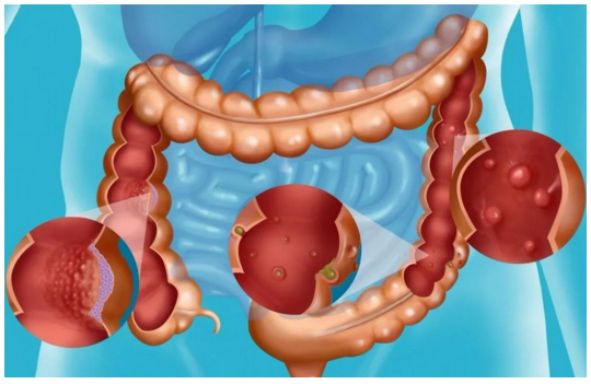 【Nature子刊】复旦大学郭伟剑团队发文：发现结肠癌预后生物标记物和治疗新靶点