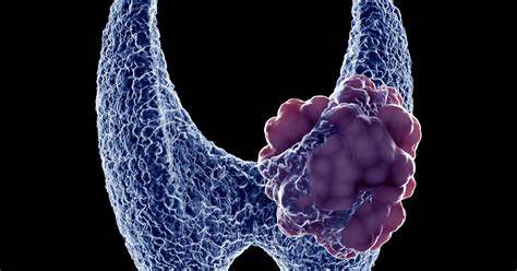 【Nature子刊】中山大学肖海鹏团队新发现：神经递质降钙素或成为抑制甲状腺髓样癌的关键！